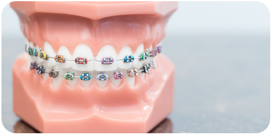 Cost of Braces (How Much Braces Really Cost?) | Fusion ...